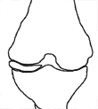 diagram of knee and COMPLETELY obliterated joint space